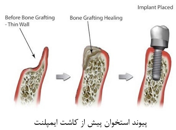 خطرات و عوارض جانبی کاشت ایمپلنت دندانی