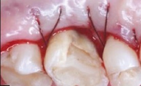 مراقبت پس از جراحی لثه (افزایش طول تاج دندان)