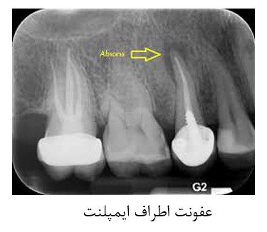 خطرات و عوارض جانبی کاشت ایمپلنت دندانی
