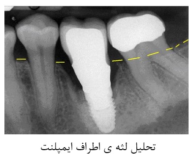 خطرات و عوارض جانبی کاشت ایمپلنت دندانی