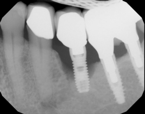 مقایسه ایمپلنت با دندان طبیعی