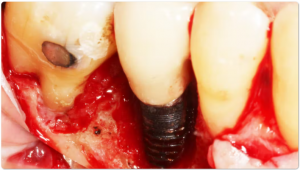 مقایسه ایمپلنت با دندان طبیعی