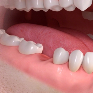 کاشت ایمپلنت دندانی پس از بیماری لثه