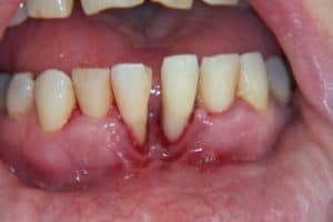 کاشت ایمپلنت دندانی پس از بیماری لثه