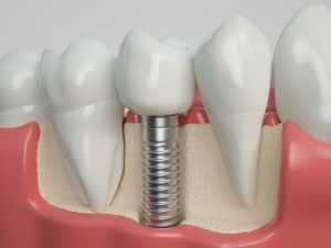 طول عمر یا دوام ایمپلنت های دندانی