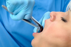 جراحی برای کشیدن دندان