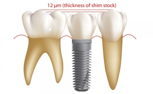 دندان قروچه و ایمپلنت