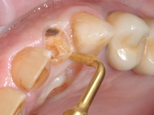 پیزوسرجری دندانپزشکی