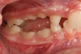 دندان انکیلوز شده یا جوش خورده به فک
