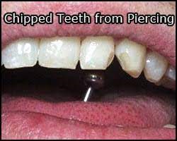 خطر پیرسینگ برای دندان و ایمپلنت دندانی