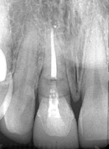 کاشت ایمپلنت دندانی با جراحی میکروسکوپی