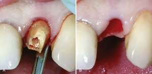 کاشت ایمپلنت دندانی با جراحی میکروسکوپی