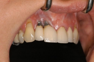 قابل مشاهده بودن ایمپلنت دندانی از زیر لثه