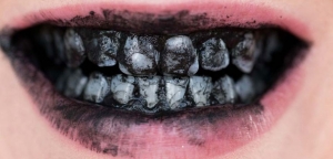 کربن فعال برای سلامت دهان و دندان