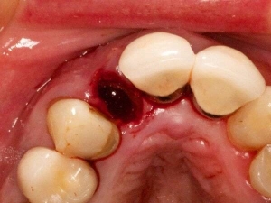 استفاده از نی بعد از کشیدن دندان