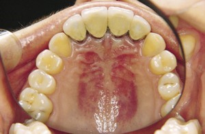 تاثیر اختلالات غذا خوردن بر سلامت دهان و دندان
