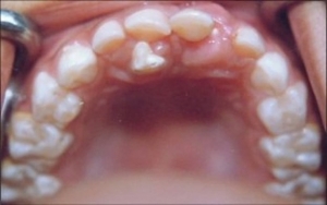 هایپردنشیا یا دندان اضافی