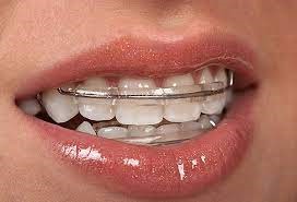 خطرات بریس های دندانی