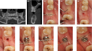 کاشت ایمپلنت دندانی با روش پانچ