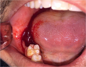 خونریزی  بعد از کشیدن دندان