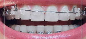 مشکلات شایع بریج های دندانی
