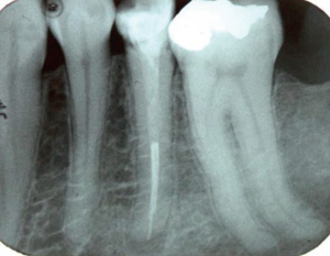 اندازه ریشه دندان