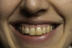 علت تغییر رنگ طبیعی دندان