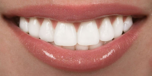 علت تغییر رنگ طبیعی دندان