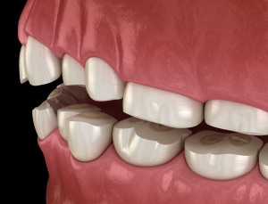 چه چیزی باعث دندان قروچه می شود؟