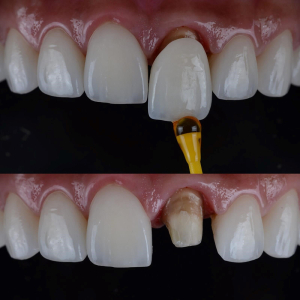 پوسیدگی دندان زیر روکش چیست؟
