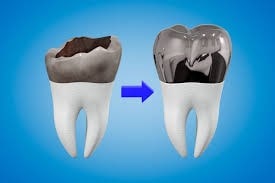 گزینه های درمانی برای پوسیدگی دندان زیر روکش