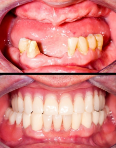 ارتباط بین بیماری لثه و از دست دادن دندان
