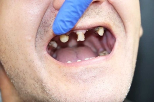 کشیدن دندان مولر سوم یا دندان عقل